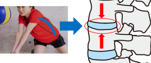 腰痛の原因 バレーボール選手に起きやすい４つの腰の怪我を知って適切に予防しよう 腰痛メディア Zen Placeが発信する痛みの情報サイト
